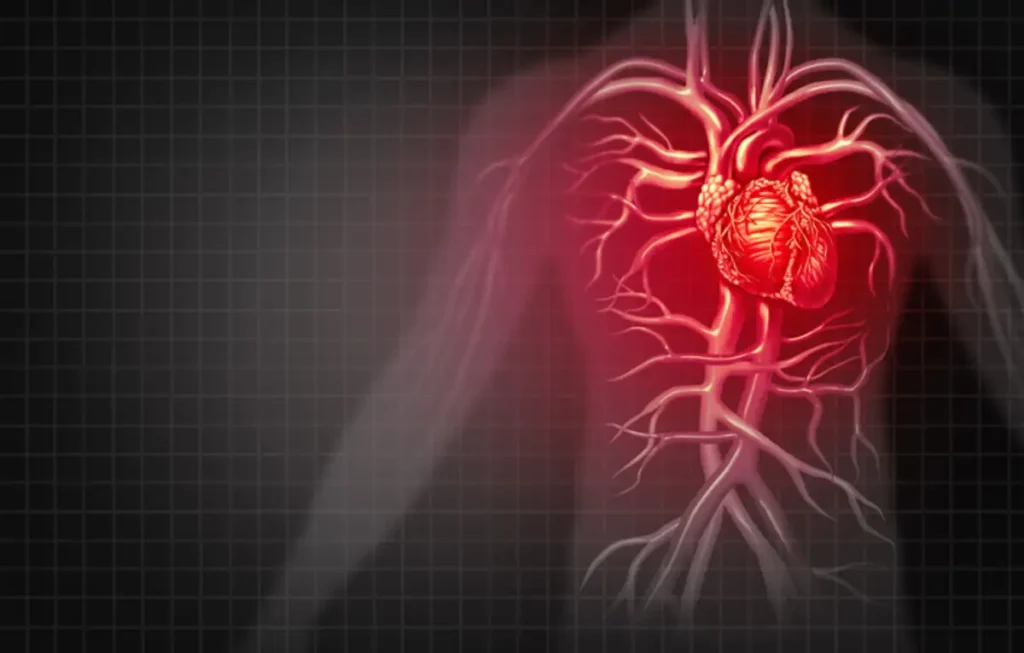 heart attack