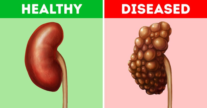 kidney disease