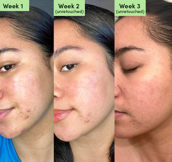 Niacinamide